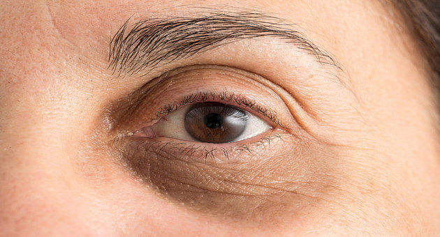 Under Eye Dark Circles Try These Natural Remedies To Get Rid Of