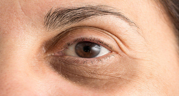 Under-Eye Dark Circles? Try These Natural Remedies To Get Rid Of
