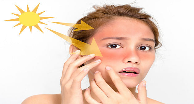 Are You Getting Sunburns? Here Are Some Natural Remedies For You