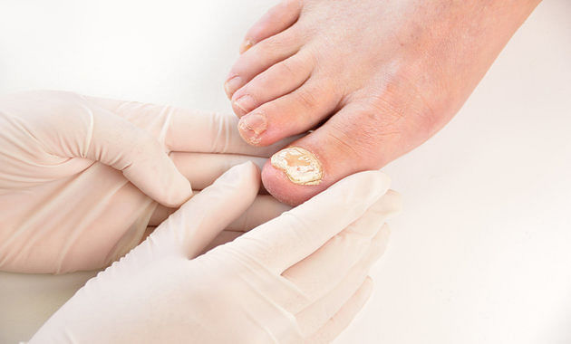 Toenail Fungus Treatment Phoenix Podiatrist | Preferred Foot & Ankle