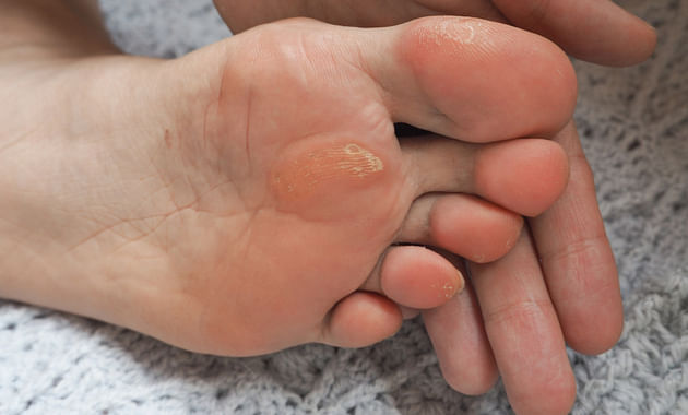 How To Prevent & Treat Feet Corns, Calluses & Cracked Heels