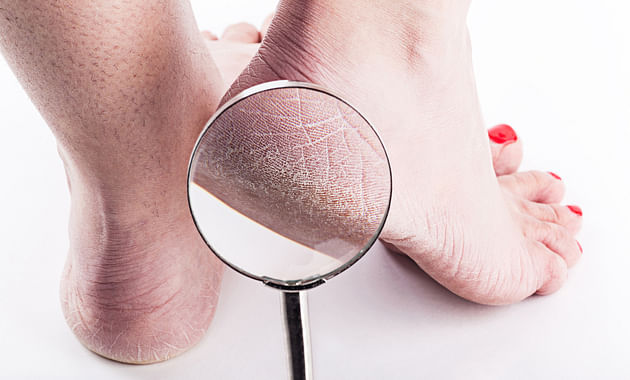 Cracked skin on feet| footcare | Hansaplast