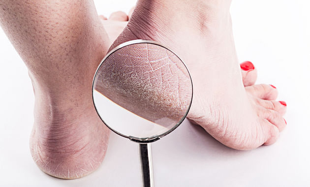 How to Heal Dry, Cracked Heels, According to the Dermatologist - Sakhiya  Skin Clinic