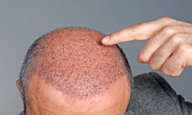 Hair Transplant: 8 Things You Should Know - Tata 1mg Capsules
