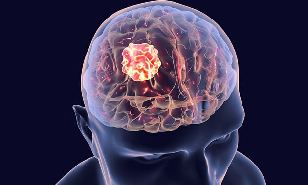 World Brain Tumor Day: Causes And Symptoms - Tata 1mg Capsules