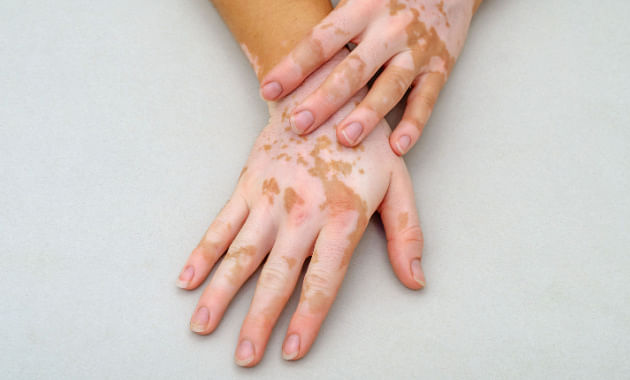 Debunking Vitiligo Myths A Rare Skin Condition Tata 1mg Capsules